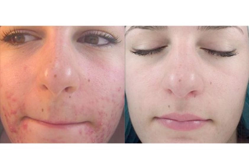 Microdermoabrasión antes y después - 501071
