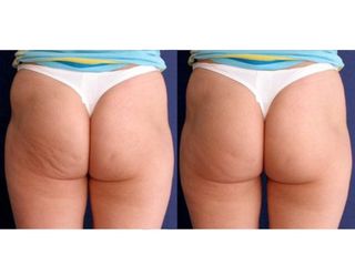 Antes y después Tratamiento ultrasonidos para combatir la celulitis