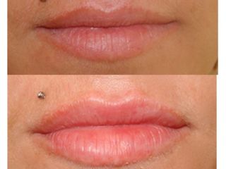Antes y después Aumento de labios con ácido hialurónico