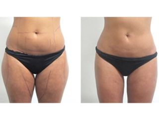 Antes y después Aqualyx (intralipoterapia)