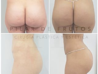 Antes y después Lipotransferencia a glúteos 