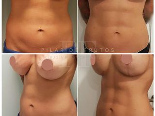 Antes y después Liposucción HD
