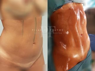 Antes y después Marcaje abdominal con Lipovaser®️ 