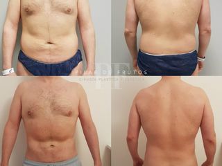 Antes y después Lipoescultura High Definition LipoVaser