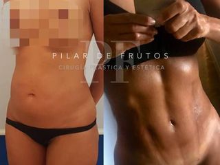 Antes y después Lipo Vaser
