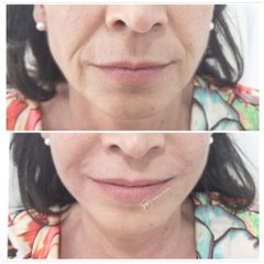 Antes y después Ellansé | Rejuvenecimiento facial