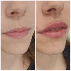 Antes y después aumento de labios