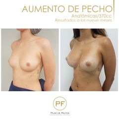 Antes y después aumento de pecho