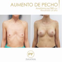 Antes y después aumento de pecho