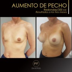 Antes y después aumento de pecho