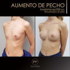 Antes y después aumento de pecho