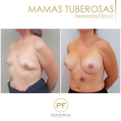Antes y después mamas tuberosas