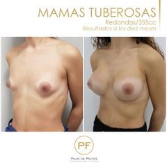 antes y después 