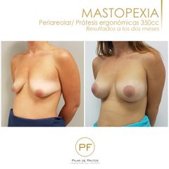 Antes y después mastopexia