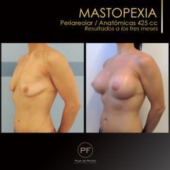 Antes y después mastopexia