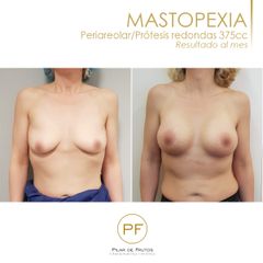 Antes y después mastopexia