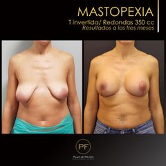 Antes y después mastopexia