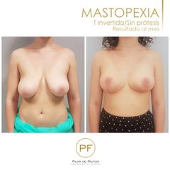 Antes y después mastopexia