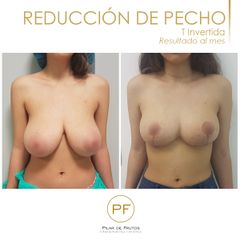 Antes y después reducción de pecho