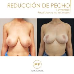 Antes y después reducción de pecho