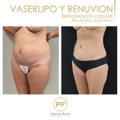 Vaser Lipo y Renuvion - Dra. Pilar De Frutos