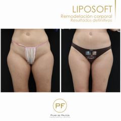 Liposoft - Dra. Pilar De Frutos