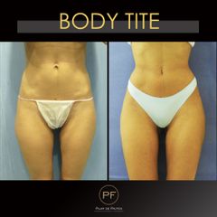 Body Tite - Dra. Pilar De Frutos