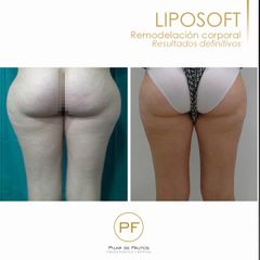 Liposoft - Dra. Pilar De Frutos