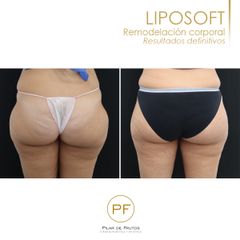 Liposoft - Dra. Pilar De Frutos