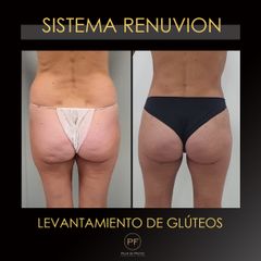 Levantamiento de glúteos - Dra. Pilar De Frutos
