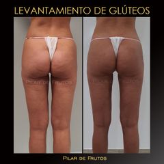 Levantamiento glúteos - Dra. Pilar De Frutos