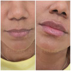 Aumento de labios - Dra. Pilar De Frutos