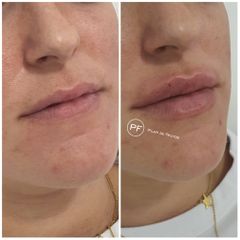 Aumento de labios - Dra. Pilar De Frutos
