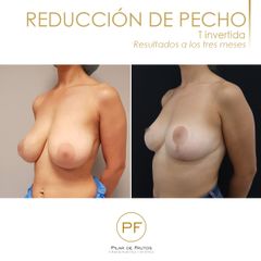 Reducción de pecho - Dra. Pilar De Frutos
