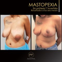 Mastopexia - Dra. Pilar De Frutos