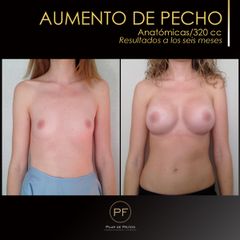 Aumento de pecho - Dra. Pilar De Frutos