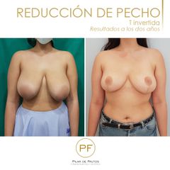Reducción de pecho - Dra. Pilar De Frutos