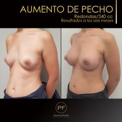 Aumento de pecho - Dra. Pilar De Frutos