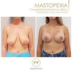 Mastopexia - Dra. Pilar De Frutos