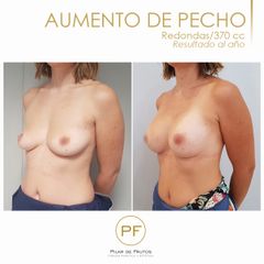 Aumento de pecho - Dra. Pilar De Frutos