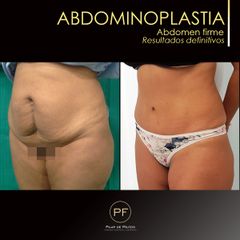 Abdominoplastia - Dra. Pilar De Frutos