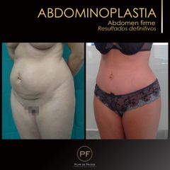 Abdominoplastia - Dra. Pilar De Frutos