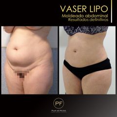 Vaser Lipo - Dra. Pilar De Frutos