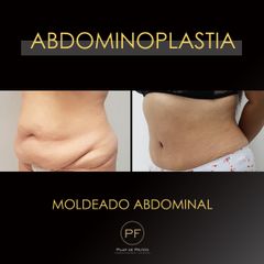 Abdominoplastia - Dra. Pilar De Frutos