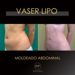Vaser Lipo - Dra. Pilar De Frutos