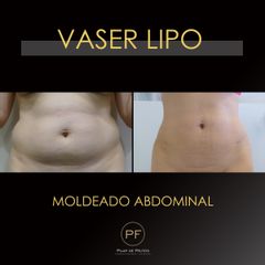 Vaser Lipo - Dra. Pilar De Frutos