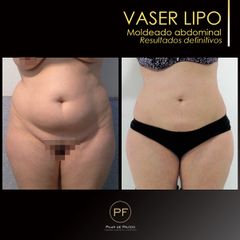 Vaser Lipo - Dra. Pilar De Frutos