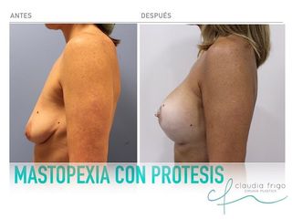 Mastopexia con Protesis
