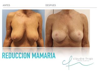 Resultado de Reducción Mamaria