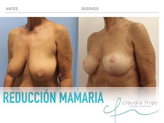 Reducción Mamaria 